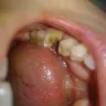 Aspen Dental - extract w/ bone remv/sectn