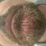 Just For Men - Beard dye severe facial burning