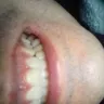 Gentle Dental - Crown