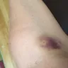 American Red Cross - injury incurred from donating blood on 6/29/17 in rochester, ny