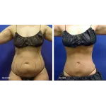 Chicago Liposuction Customer Service Phone, Email, Contacts