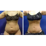 Chicago Liposuction