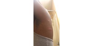 Baymont Inn & Suites - bed bugs