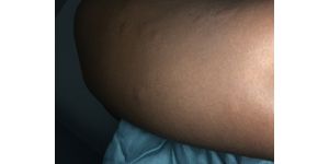 La Quinta Inns & Suites - Bed bugs