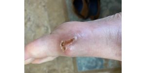 Carnival Cruise Lines - Medical injury on mardi gras ship 3/29/22 suite 9415