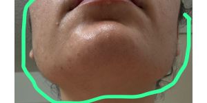 LaserAway Medical Group - No results facial hair increased (do not recommend)