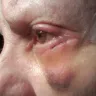 Sono Bello - under eye lift. $5k and a mess to repair. stay away!! - Photo 1