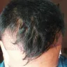 Kolors Health Care India - hair transplantation