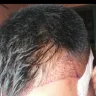 Kolors Health Care India - hair transplantation