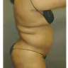 Sono Bello - liposuction - Photo 2