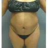 Sono Bello - liposuction - Photo 3