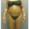 Sono Bello - liposuction - Photo 4