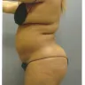 Sono Bello - liposuction - Photo 6