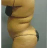 Sono Bello - liposuction - Photo 7