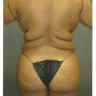 Sono Bello - liposuction - Photo 8
