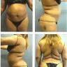 Sono Bello - liposuction - Photo 9