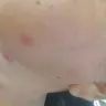 Motel 6 - bed bug bites