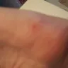 Motel 6 - bed bug bites