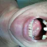 Western Dental Services - having my teeth get fixed