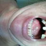 Western Dental Services - having my teeth get fixed - Photo 1