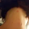 La Quinta Inns & Suites - bed bugs at la quinta - Photo 1