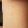 La Quinta Inns & Suites - bed bugs at la quinta