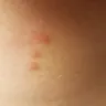 La Quinta Inns & Suites - bed bugs at la quinta - Photo 3