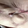 Strax Rejuvenation - tummy tuck - Photo 1
