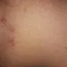 Motel 6 - bitten by bed bugs - Photo 1