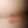 Motel 6 - bitten by bed bugs - Photo 2