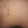 Motel 6 - bitten by bed bugs - Photo 3