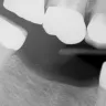 Aspen Dental - services provided-specifically a crown that lasted 18 months - Photo 1