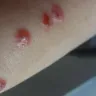 La Quinta Inns & Suites - bed bites, horrible manager and gm - Photo 2