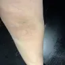 Quest Diagnostics - phlebotomist hit the nerve - Photo 2
