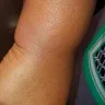 Motel 6 - Bed bugs - Photo 11