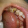 Aspen Dental - extract w/ bone remv/sectn - Photo 1