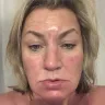 VG Medispa - peel treatment - Photo 1
