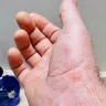 Holiday Inn - bed bugs biting when staying overnight - Photo 1