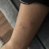 Westgate Resorts - bed bugs inside my hotel room - Photo 1