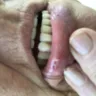 Aspen Dental - dentures