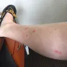 Great Wolf Lodge - bedbugs - Photo 1
