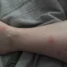 Great Wolf Lodge - bedbugs - Photo 2