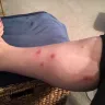 Great Wolf Lodge - bedbugs - Photo 3