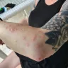 Sandals Resorts - bed bug infestation