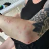 Sandals Resorts - bed bug infestation - Photo 2