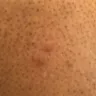 Sandals Resorts - bed bug infestation - Photo 5