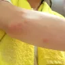 AirAsia - bug bite on plane - Photo 1