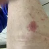 Motel 6 - bitten by a bug - Photo 1