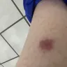 Motel 6 - bitten by a bug - Photo 2