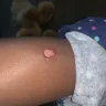 The Cheesecake Factory - burns on child from pizza - Photo 1